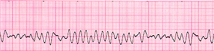 ECG strip